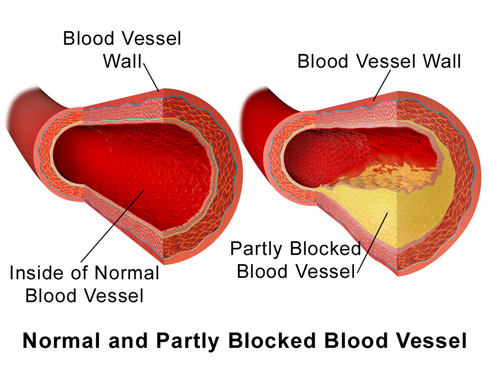 Ways to Lower Cholesterol - Why a Diet Low in Fat and Cholesterol Can Help You