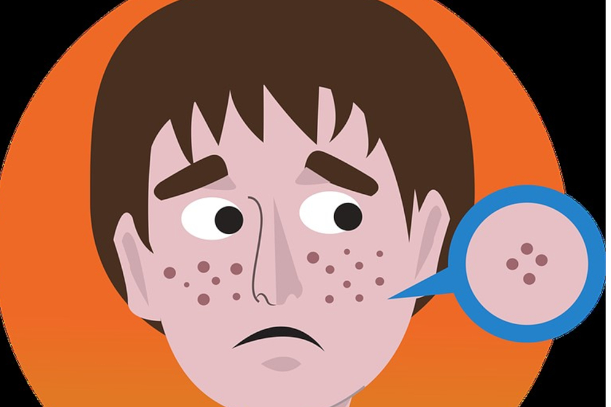 Help for Acne