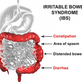 irritable bowel