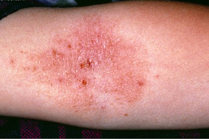 Eczema