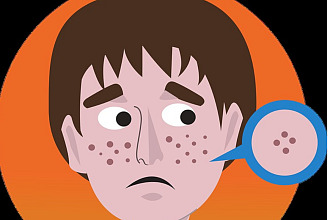 Help for Acne